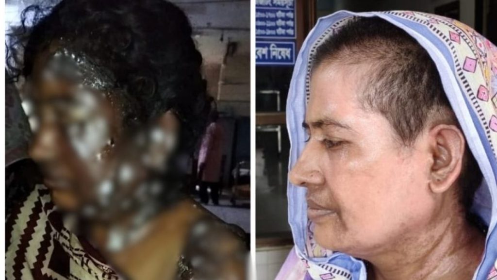 গরম পানি-মরিচে ঝলসে যাওয়া শাহানাজ ফিরে পেল জীবন, পাশে ছিল সেনাবাহিনী