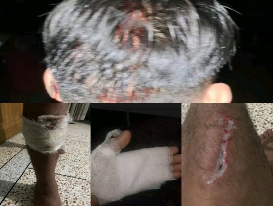 চট্টগ্রামে ইউপিডিএফের সন্ত্রাসী হামলায় আহত ৬ শিক্ষার্থী