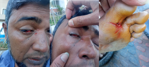 সাজেকে বনবিভাগের কার্যালয়ে ইউপিডিএফের হামলা-ভাঙচুর: বনরক্ষি আহত, ব্যর্থ অপহরণচেষ্টা