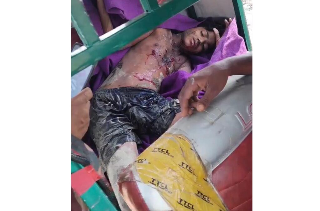 কক্সবাজারের উখিয়া সীমান্তে মাইন বিস্ফোরণে রোহিঙ্গা যুবক আহত