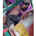 কক্সবাজারের উখিয়া সীমান্তে মাইন বিস্ফোরণে রোহিঙ্গা যুবক আহত