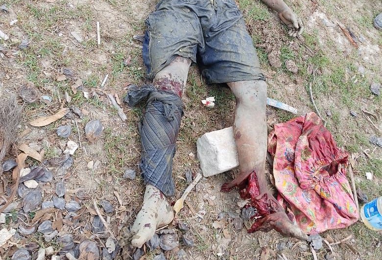 উখিয়া সীমান্তে মাইন বিস্ফোরণে রোহিঙ্গা যুবকের পা ক্ষত-বিক্ষত