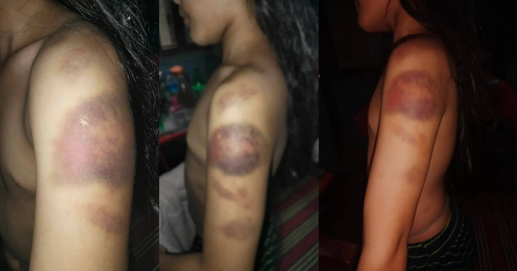 রাঙামাটিতে শিক্ষিকার বেত্রাঘাতে তৃতীয় শ্রেণির ছাত্রী শ্রমনা চাকমা আহত, তদন্তের দাবি